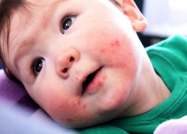 Viral Lesions