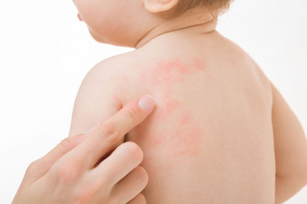 Atopic Dermatitis