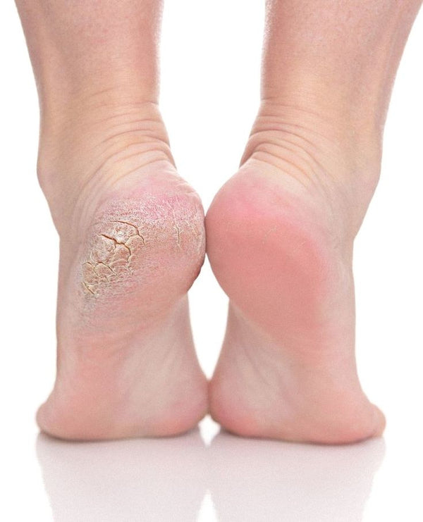 Cracked Heel