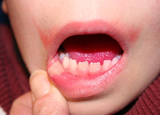 Oral Lesions