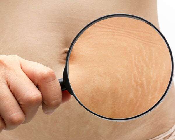 Stretch Marks