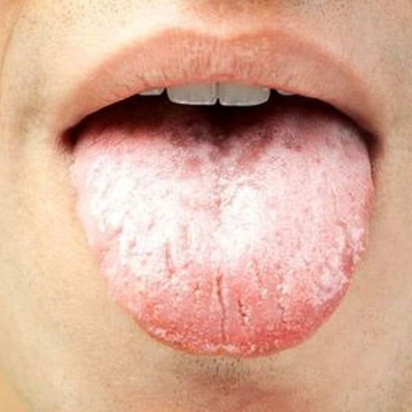 Oral Thrush