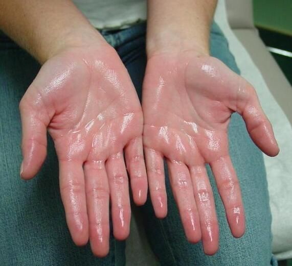 Hyperhydrosis