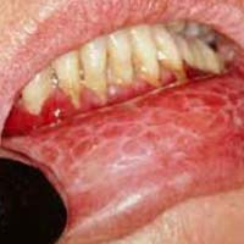 Oral Lichen Planus