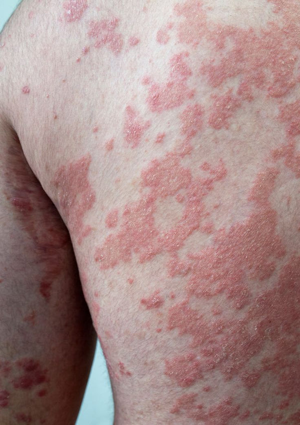 Psoriasis