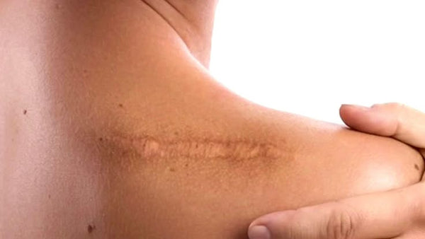 Scars & Keloids