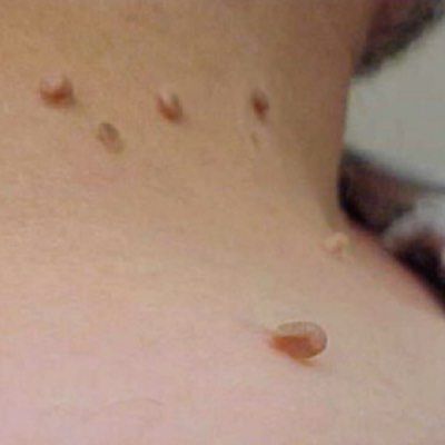 Warts