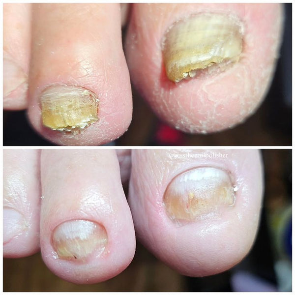 Ingrown Toe Nail