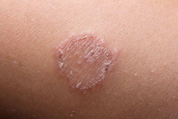 Fungal Infections