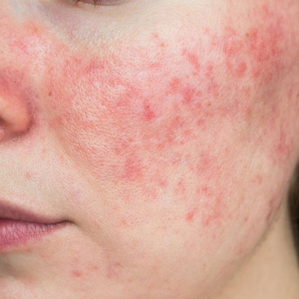 Rosacea