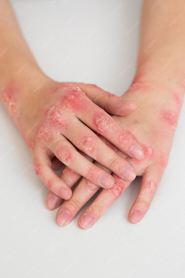 Eczema