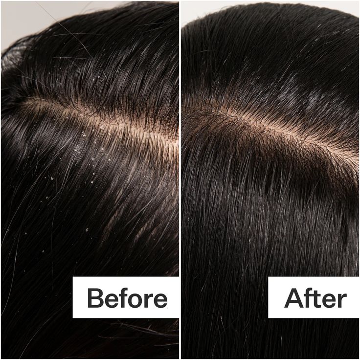 Anti-Dandruff