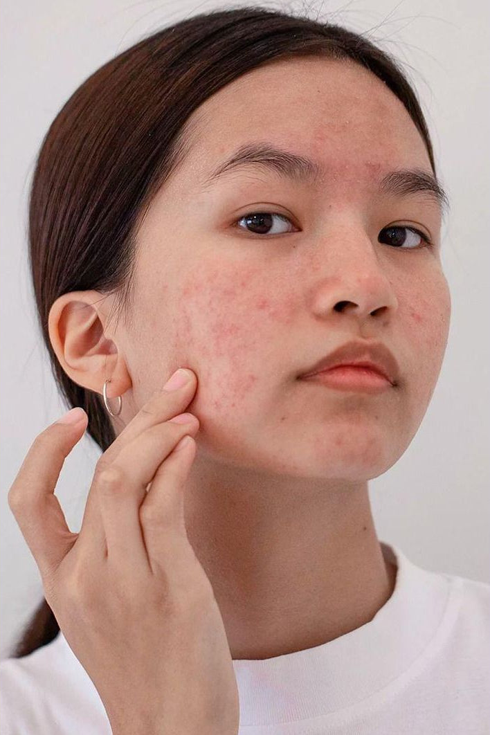 Acne & Breakouts