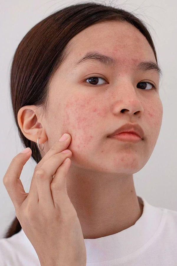Acne & Oily Skin