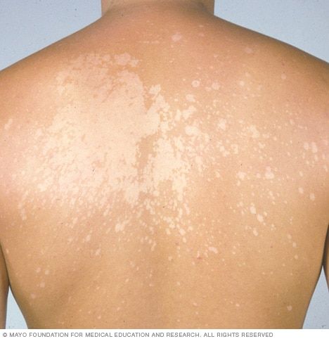 Vitiligo & Discolouration