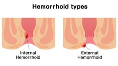 Hemorrhoids