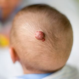 Hemangioma