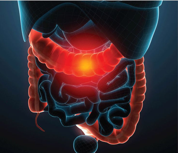 Ulcerative Colitis