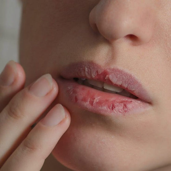 Dry Mouth