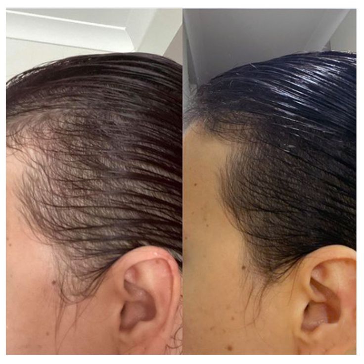 Hair Loss & Thinning